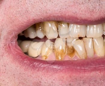 Close up macro of teeth of patient with receding gums and bad plaque on uneven teeth prior to cleaning and root planing