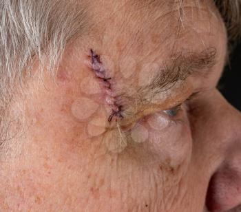 Senior adult male with stitches in the cut after surgery for removal of basal cell carcinoma caused by sun damage