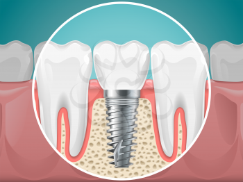 Stomatology illustrations. Dental implants and healthy teeth. Vector health tooth and implant stomatology, dentistry installation and fixture