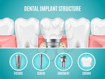 Dental implant structure. Vector reallistic tooth implant cut. Dental surgery banner. Illustration anatomical healthy artificial tooth, dentistry replacement implant
