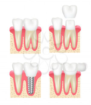 Dental crown. Tooth veneer implants healthy cavity stomatology dentist vector collection. Medical implant, dental crown for tooth illustration