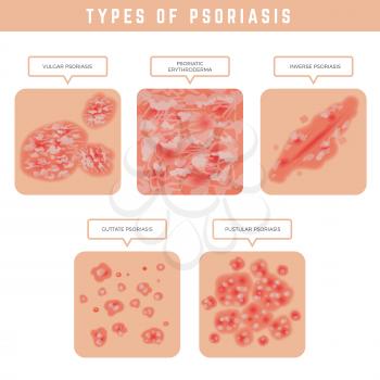 Psoriasis types. Skin problems close up medical illustrations vector set. Psoriasis problem, eczema skin disease, epidermis dermatitis