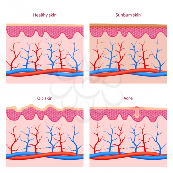 Skin types and healthy, sunburn and old skin, acne vector set. Human skins layer illustration
