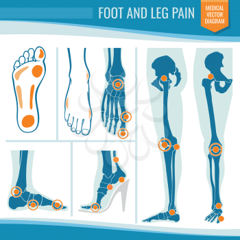 Foot and leg pain. Arthritis and rheumatism orthopedic medical vector diagram. Illustration of rheumatism leg joint