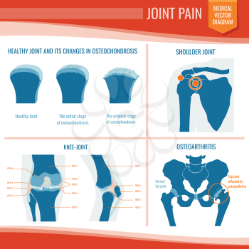 Osteoarthritis and rheumatism joint pain medical vector infographic. Arthritis and rheumatism, osteoarthritis disease, medical orthopedic illustration