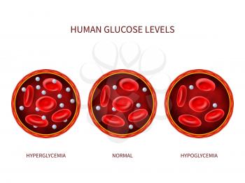 Human glucose levels hyperglycemia, normal, hypoglycemia. Hematology vector diagram with blood vessel, erythrocytes and sugar. Illustration of diabetic illness, disease diagnostic
