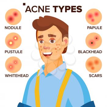 Acne Types Vector. Man With Acne. Facial Skin Problems. Papule, Pustulem Scards. Isolated Flat Cartoon Illustration