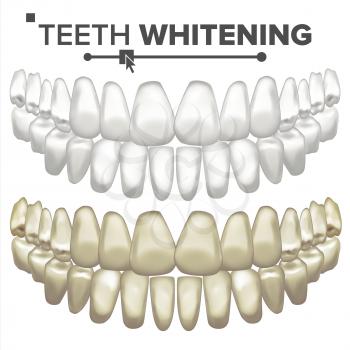 Teeth Whitening Vector. Before And After. Tooth Veneer Whitening. Isolated Illustration