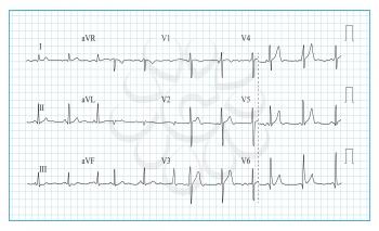 Heart Cardiogram Chart Vector. Illustration Of Wave Form On Checked Ecg Graph. Heart Rhythm, Ischemia, Infarction. Heartbeat