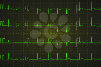 Typical human electrocardiogram, bright green graph on dark background with marks