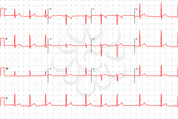 Typical human electrocardiogram, red graph with marks on white