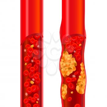 Healthy and blocked arteries with red erythrocytes, high cholesterol concept illustration on white