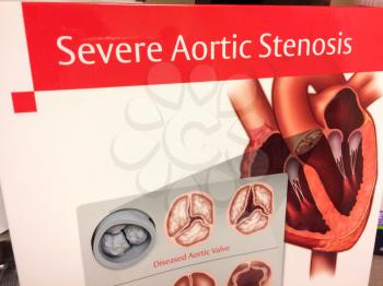 Cardiac Heart education pamphlet severe aortic stenosis